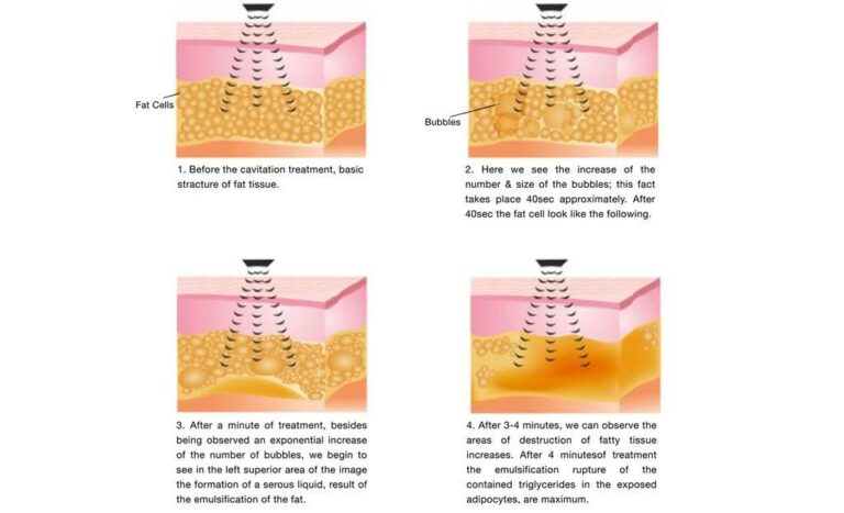 Cavitation teknisk