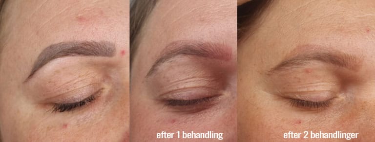 Priser på fjernelse af PMU (permanent makeup)