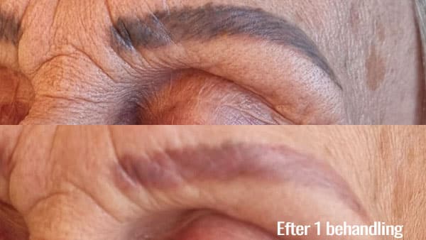 Pris på tatoveringsfjernelse